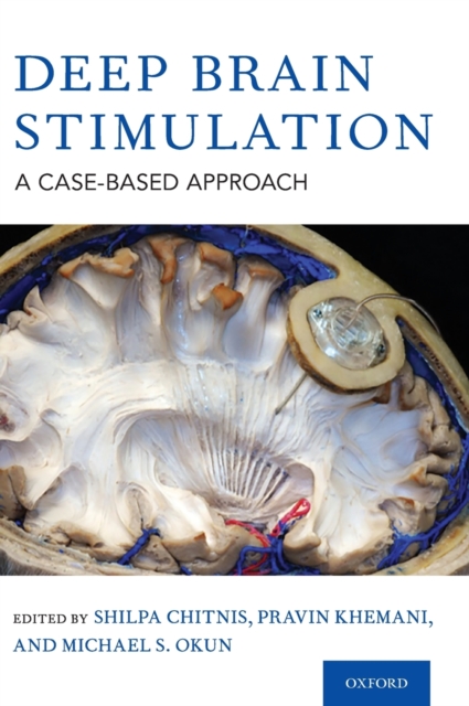 Deep Brain Stimulation