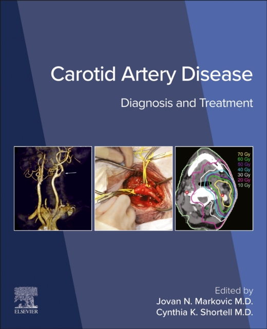 Carotid Artery Disease