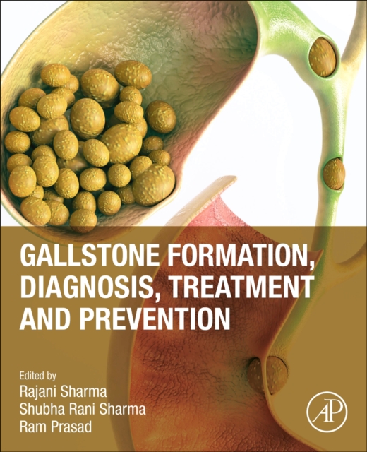 Gallstone Formation, Diagnosis, Treatment and Prevention