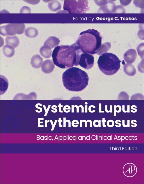 Systemic Lupus Erythematosus