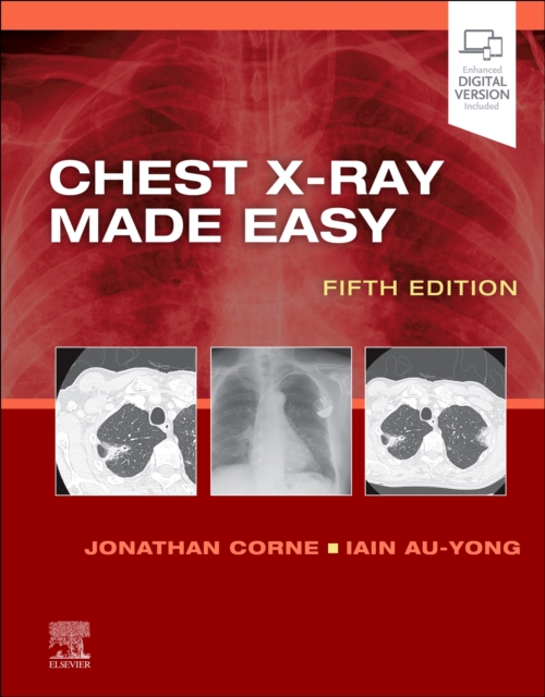 CHEST XRAY MADE EASY