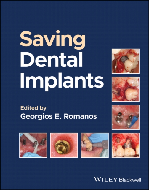 Saving Dental Implants