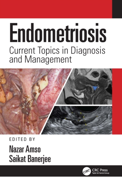 Endometriosis