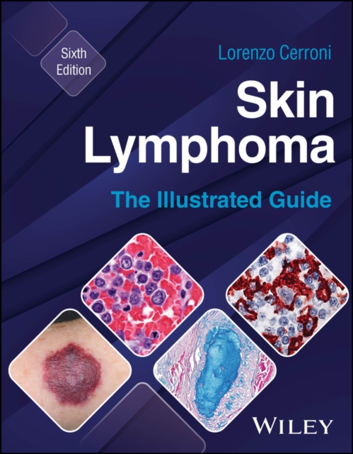 Skin Lymphoma