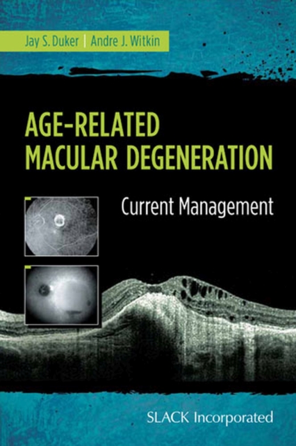 Age-Related Macular Degeneration