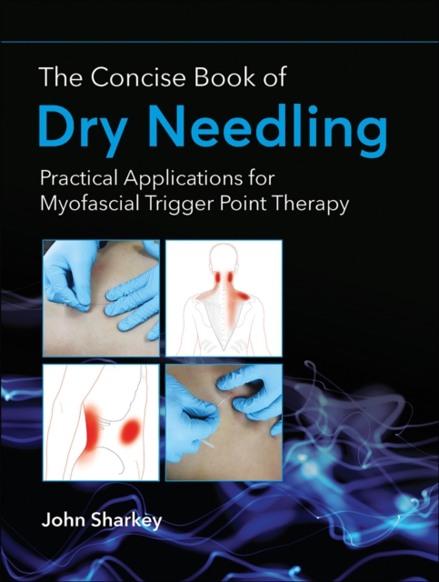 The Concise Book of Dry Needling