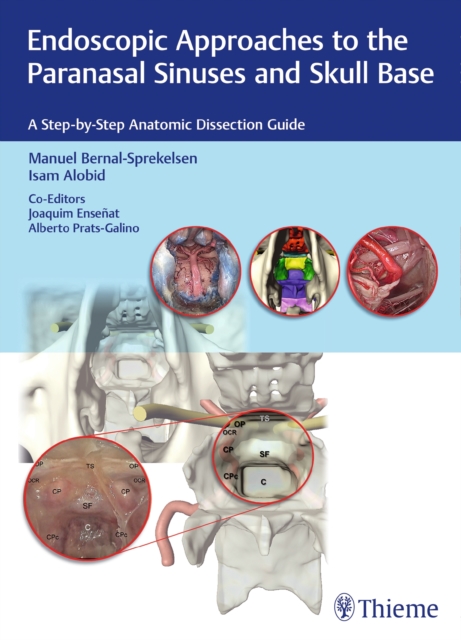 Endoscopic Approaches to the Paranasal Sinuses and Skull Base