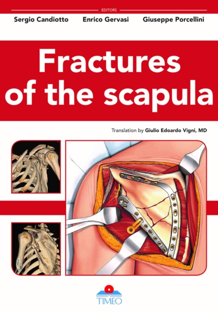 Fractures of the Scapula