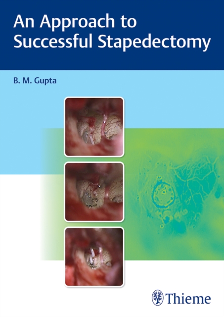 Approach to Successful Stapedectomy